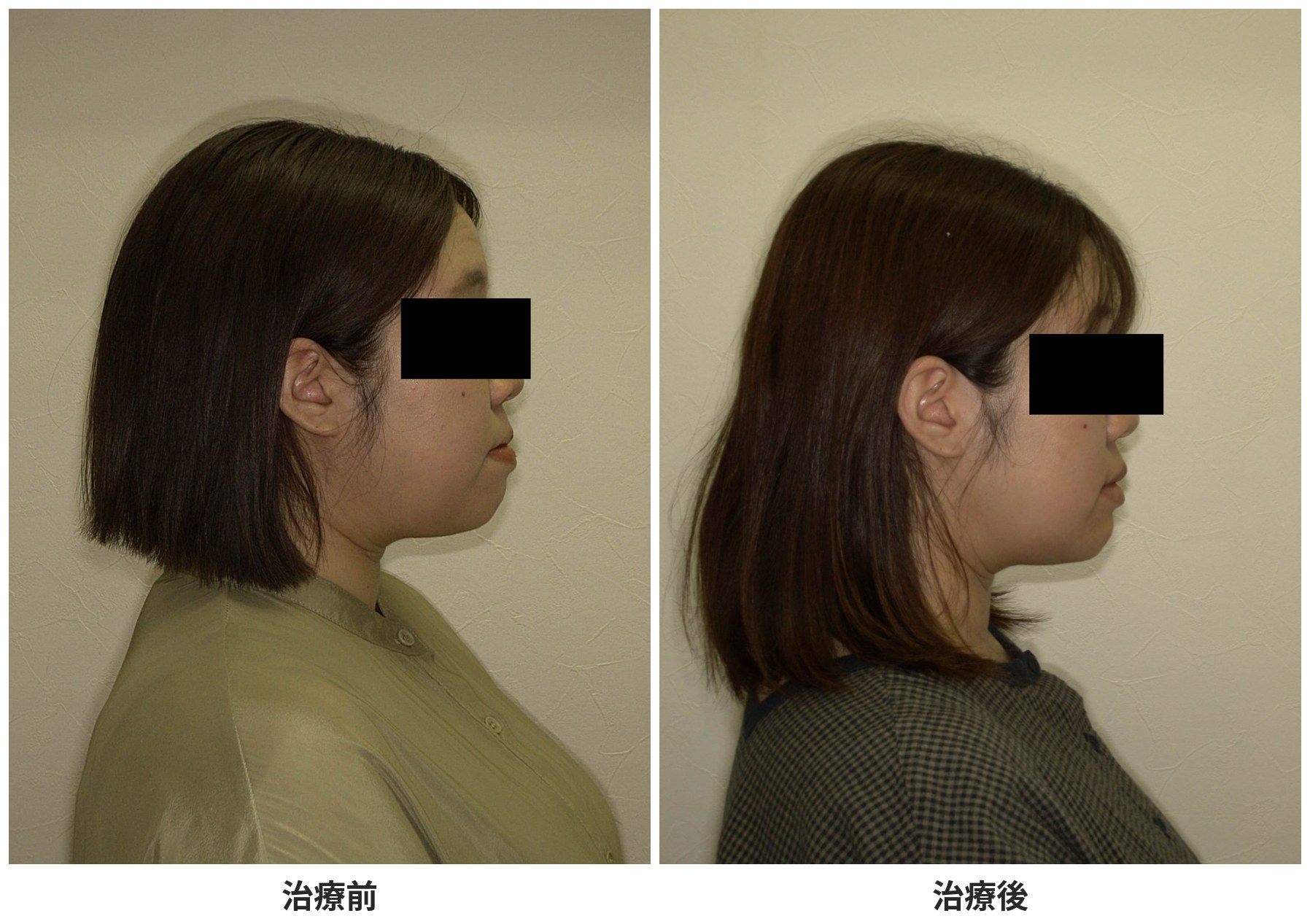 反対咬合の矯正治療 治療前後の横顔 33歳女性 下唇の突出が改善